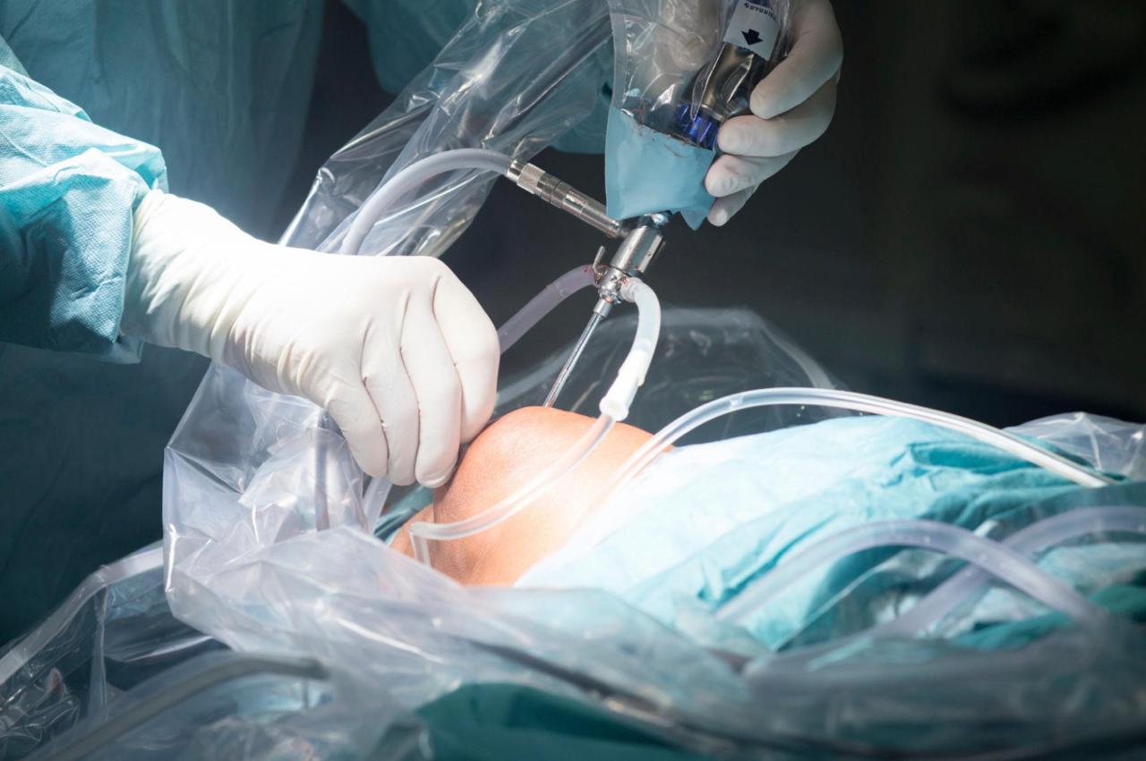 Meniscus surgery and knee arthroscopy in Bangalore